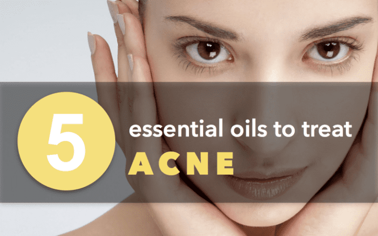 5-essential-oils-to-heal-acne-exclusive-skin-care