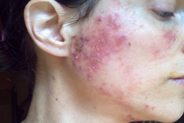 Staph Infection On The Face And Body